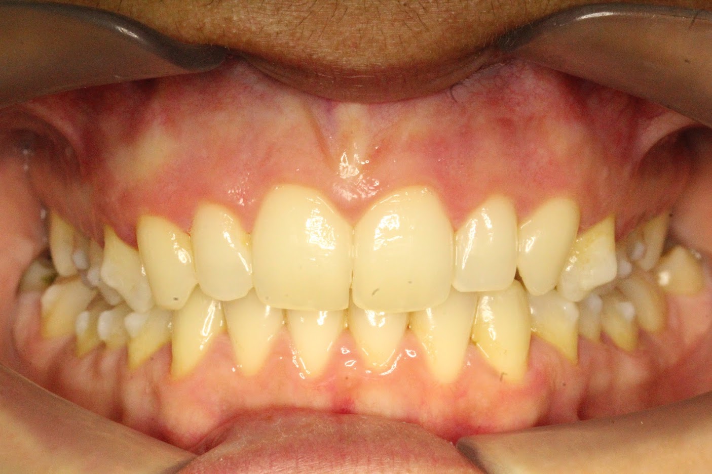 after aligner