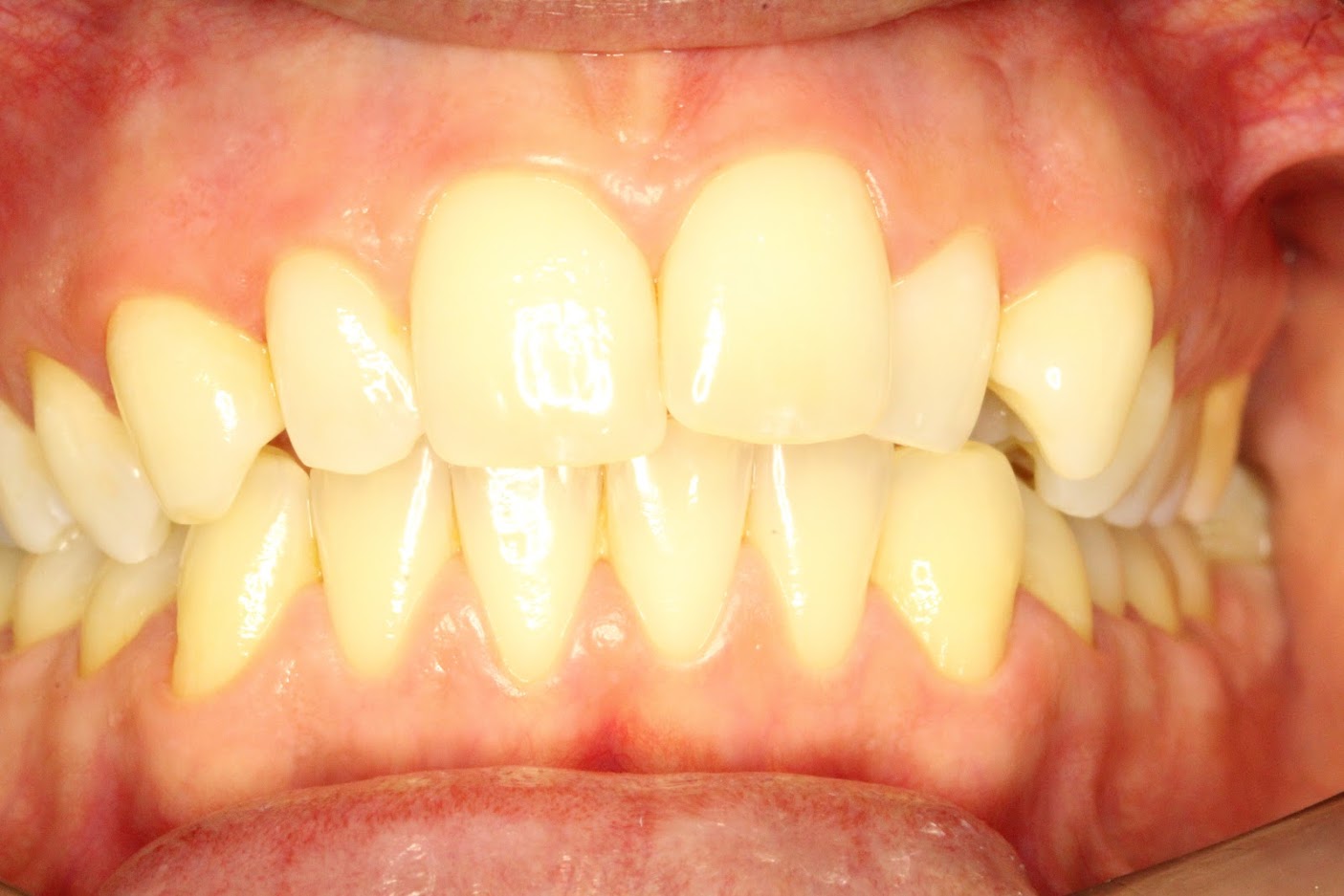 before aligner