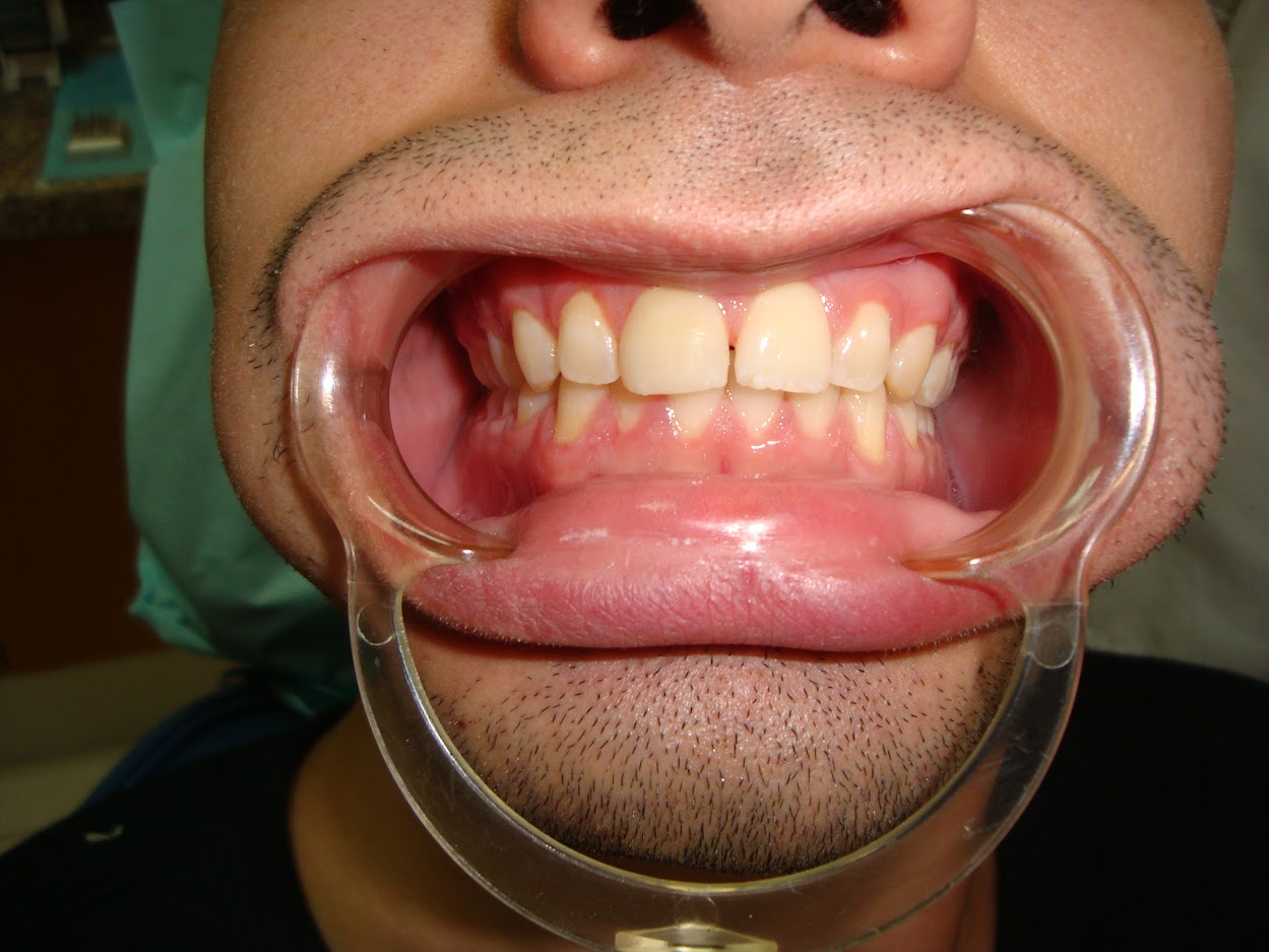 dental bonding after
