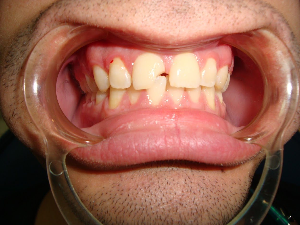 dental bonding before